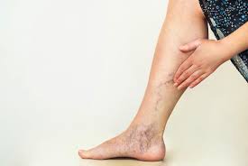 Chronic Venous Insufficiency